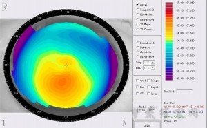 角膜地形图图片
