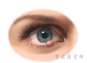 孩子眼睛上长麦粒肿 能否配戴角膜塑形镜？